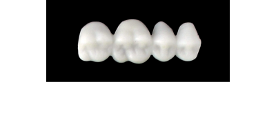 Cod.SXUPPER RIGHT : 15x  posterior solid (not hollow) wax bridges, X- LARGE , (14-17) , with precarved occlusion to Cod.SXLOWER RIGHT,and compatible to Cod.EXUPPER RIGHT (hollow), (14-17)